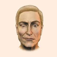 Гемифациальный спазм (лицевой гемиспазм)